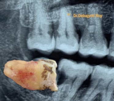 Surgical Extractions & Structural Analysis